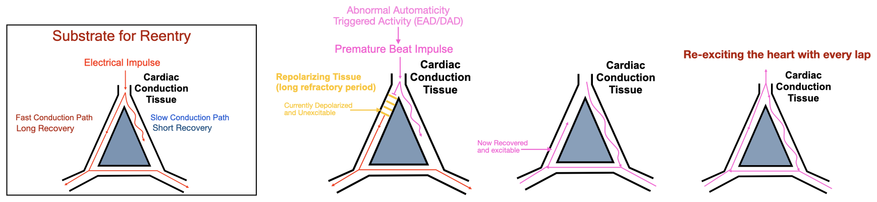 Four-panel diagram showing a substrate with two conduction pathways, a premature trigger encountering unidirectional block, delayed conduction through recovered tissue, and repeated circulation around the circuit.
